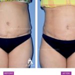 Case 1 Vaser Liposuction Post Abdominoplasty