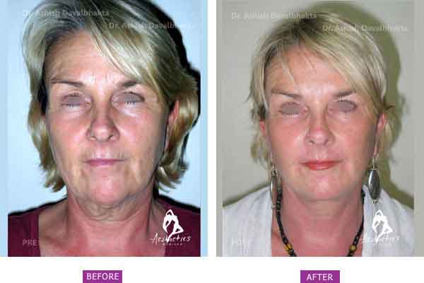 Facelift Surgery Case 1: Upper and lower eyelid blepharoplasty, facelift, necklift