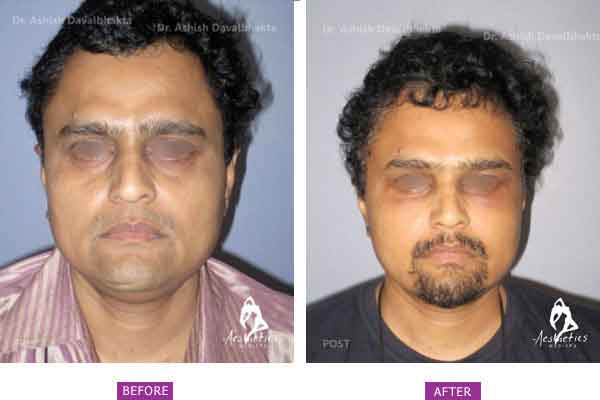 Facelift Surgery Case 2: Brow Lift, upper and lower blepharoplasty and facelift