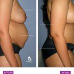 Mommy Makeover Case 1: Post pregnancy sagging/deflation