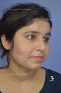 Acne Scar Treatment 5