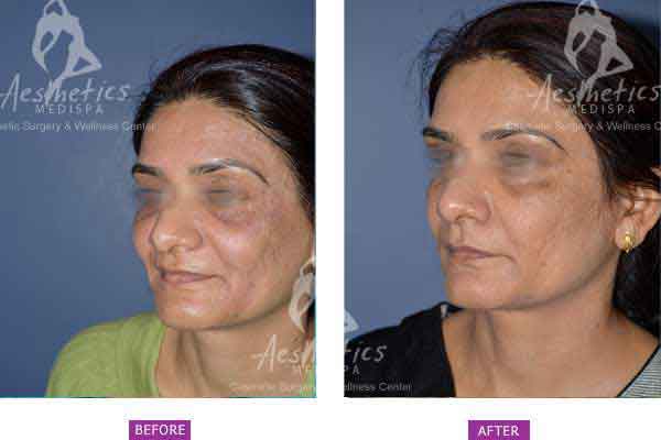 Case 4: Botox and fillers