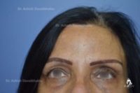 Case 6: Elimination of forehead lines by botox