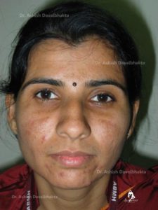 Skin Glow improvement with glycolic peels (before)