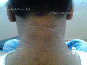 Glycolic Peels for neck pigmentation (After)