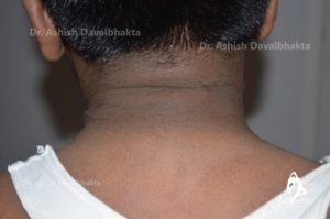 Glycolic Peels for neck pigmentation (Before)