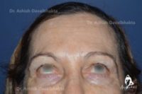 Elimination of forehead lines by botox