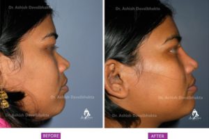 Rhinoplasty Case 3: Augmentation with DCF : Side View