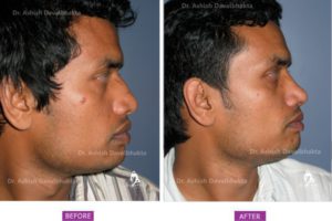 Rhinoplasty Case 6: Narrowing with Hump Reduction and Lip Reduction : Side View