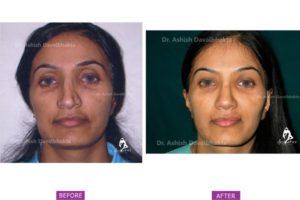 Rhinoplasty Case 11 : Correction of Deviation