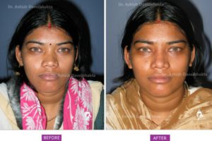 Rhinoplasty Case 3: Augmentation with DCF : Front View