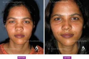 Rhinoplasty Case 4: Correction of Deviation and Saddle with DCF : Front View