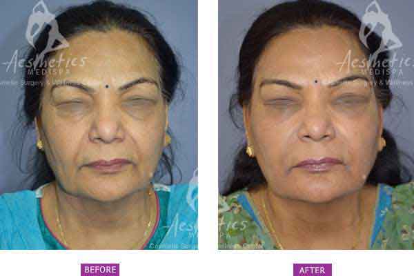 Case 3: Fillers and Botox Treatment