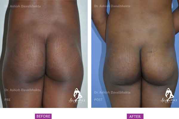 Buttock Augmentation Case 2 back view