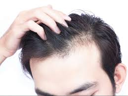 Read more about the article Hair Loss Treatments