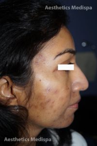 Acne case 2 : right view (before)