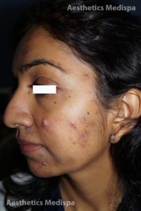 Acne case 2 : left view (before)