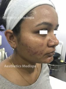 Acne case 4 : right view (before)