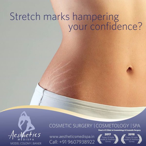 Stretch Mark Reduction