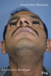 Case 17 (Before) : A Broad nose, with deviation, hump and flared nostrils : Top View