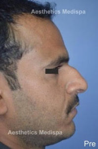 Case 17 (Before) : A Broad nose, with deviation, hump and flared nostrils : Side View