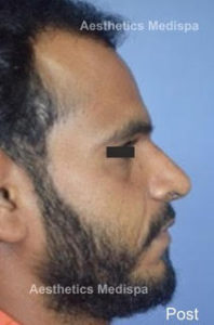 Case 17 (After) : A Broad nose, with deviation, hump and flared nostrils : Side View