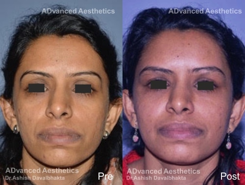 Case 2: Full facial recontouring with fat grafting