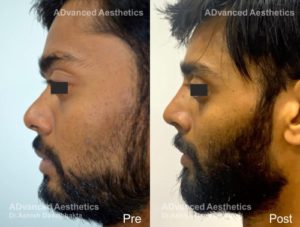 Case 18: Nose Augmentation with Rib Cartilage Graft : Side View