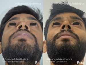 Case 18: Nose Augmentation with Rib Cartilage Graft : Top View