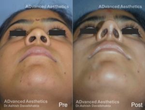 Case 15 : Nose augmentation with Rib Cartilage Graft : Basal View