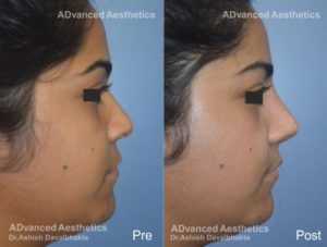 Case 15 : Nose augmentation with Rib Cartilage Graft : Side View