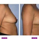 Case 7 : Breast Augmentation : Side View