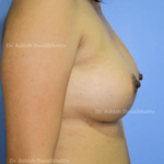 Case 3 : Breast Augmentation : Side View (After)