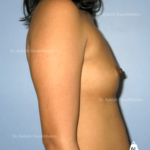 Case 3 : Breast Augmentation : Side View (Before)