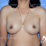 Case 1 : Breast Augmentation : 400cc Silicone Dual Plane 1 Implant
