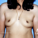 Case 1 : Breast Augmentation : Grade 0 ptosis, Double A Cup