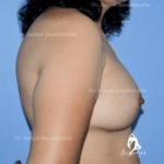 Case 1 : Breast Augmentation : Side View (After)