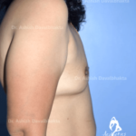 Case 1 : Breast Augmentation : Side View (Before)