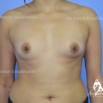 Case 5 : Breast Augmentation Surgery : 355 Silicone Dual Plane 1 Implant : (Before)