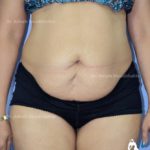 lipoabdominoplasty_CASE_8A-PRE