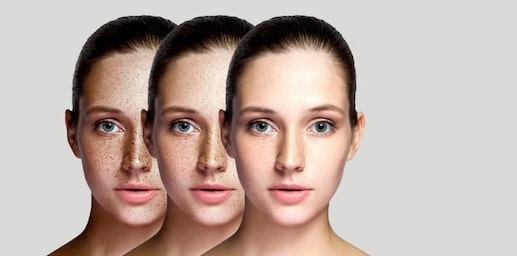 skin pigmentation treatment