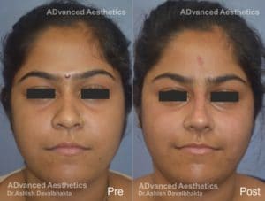 Case 15 : Nose augmentation with Rib Cartilage Graft : Front View