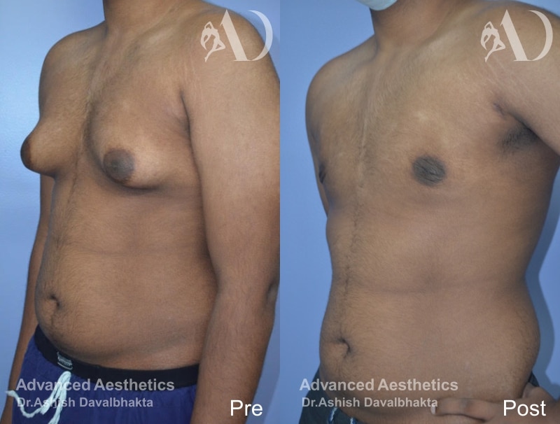 Grade III Gynaecomastia Case