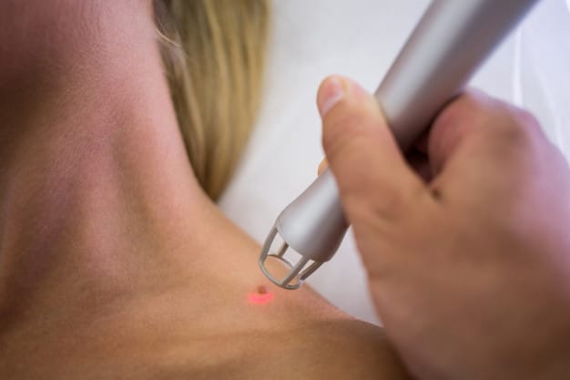Read more about the article Keloid Management, Skin Tags, Warts, Comedones, And Moles