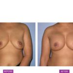Case 7 : Breast Augmentation : Front view