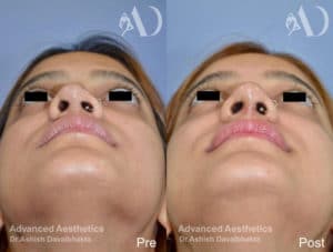 Case 16 : Revision rhinoplasty before-after Basal View