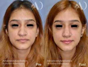 Case 16 : Revision rhinoplasty before-after Front View
