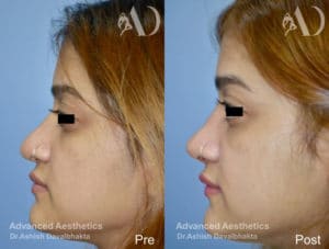 Case 16 : Revision rhinoplasty before-after Side View