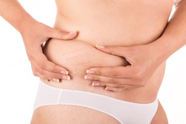 Read more about the article Stretch Marks Reduction