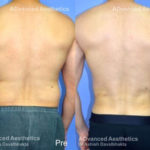 Case 5 : Vaser 4D liposuction : Back View